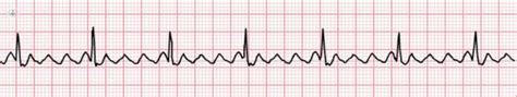 Identifying And Treating Atrial Flutter