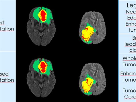 After a lot of research to study mammalian brains, researchers found that specific parts of the brain they have used this for segmentation of neuronal structures in electron microscopic stacks and few other biomedical image segmentation datasets. BRATS 2017 Glioma segmentation using Fully Convolutional ...