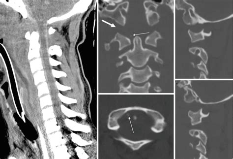 Spine Trauma Radiology Key