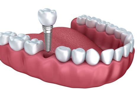 Single Dental Implants In Leicestershire