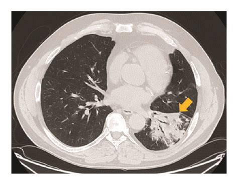 Computed Tomogram Ct Of The Chest Mediastinal Window In Horizontal