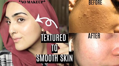 How To Get Rid Of Textured Bumpy Skin And Get Smooth Glowing Skin