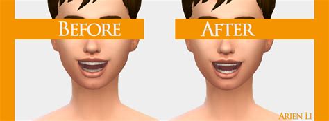 Sims 4 Teeth Replacement