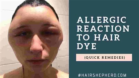 How Long Does An Allergic Reaction To Hair Dye Last