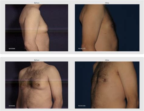 Male Breast Surgery Holzapfel Lied Plastic Surgery