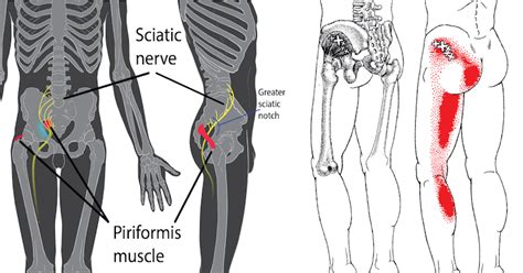 You can avoid pulled lower back muscles by taking some simple protective steps. Piriformis Syndrome: How To Detect It, Plus 10 ...
