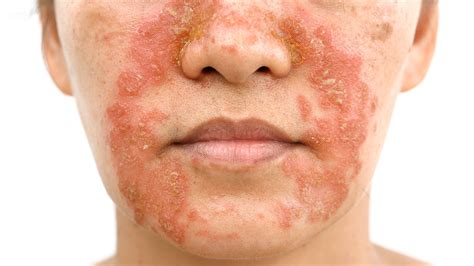 Skin Rashes On Face Hot Sex Picture