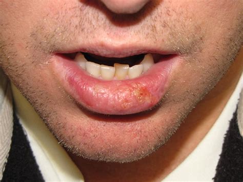 Squamous Cell Carcinoma Lower Lip Skin Cancer And Reconstructive