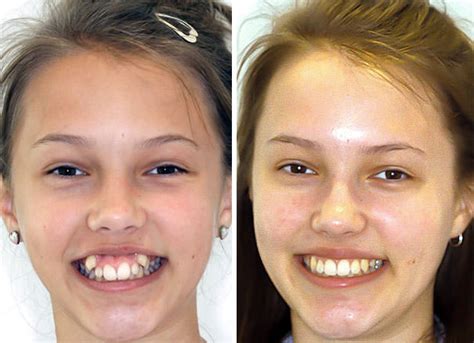 Before And After Braces Incredible Transformations Of People Who Wore