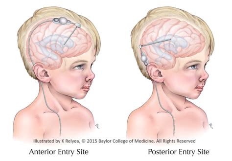 Csf Shunt Entry Site Trial Hydrocephalus Association