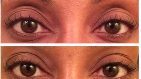 After a typical 4 month consistent usage, if latisse is discontinued the lash effects tend to last up to. How to get Long Eyelashes - Latisse Does it Work update ...