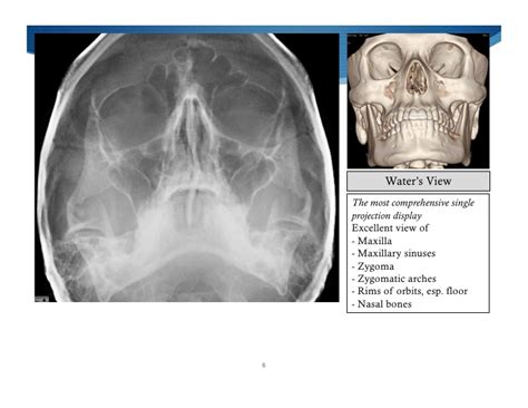 Imaging Of Facial Trauma Part 2