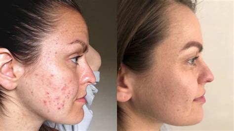 My Journey From Adult Acne To Clear Skin Lena Wild