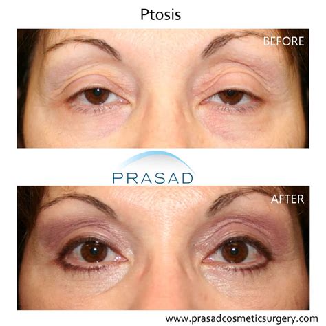 ptosis surgery before and after photos amiya prasad md facs