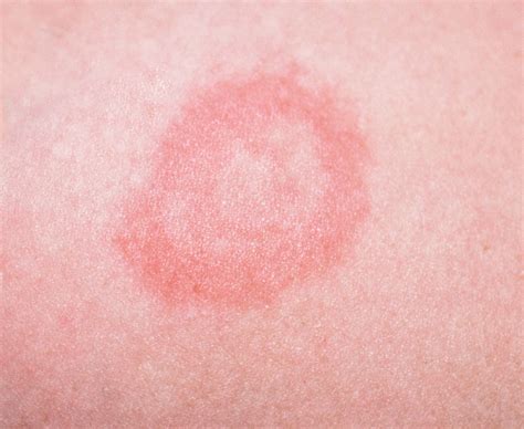 Infant Rashes Disease Is A Circular Rash