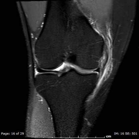 Grade i is stretching of the ligament or a very mild tear, with little or no instability at the joint. Viewing playlist: AAA_PIN-JUNE | Radiopaedia.org ...