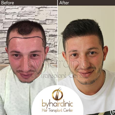 11 Best Place To Do Hair Transplant In Turkey PNG Backpacker News