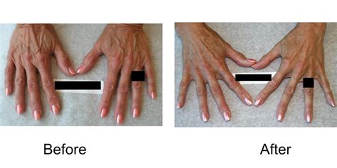 Hand Vein Treatments In Waunakee Wi