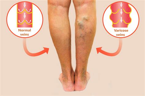 Anistreplase As Related To Deep Vein Thrombosis Pictures