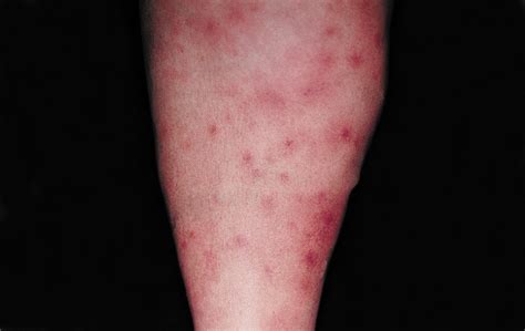 Diffuse Recurrent Tender Pustules Papules And Arthritis Dermatology