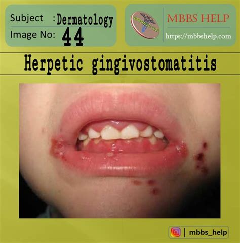 Mbbshelp Com On Tumblr Herpetic Gingivostomatitis Is A Common Infection Of The Mouth And Gums