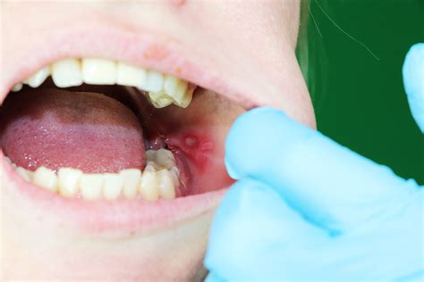 What Causes Canker Sores On Tongue And Lips