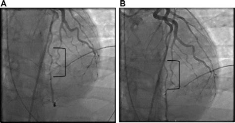 A Type 2a Scad Coronary Angiography Showing Abrupt Narrowing Of The