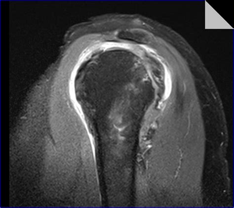 Shoulder Impingement Syndrome And Tears Of The Rotator Cuff Neill