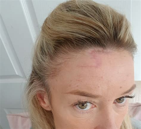 Woman Left With Harry Potter Scar After Skin Cancer Removed From Forehead