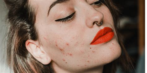 Cheek Acne Causes And Treatments According To Derms