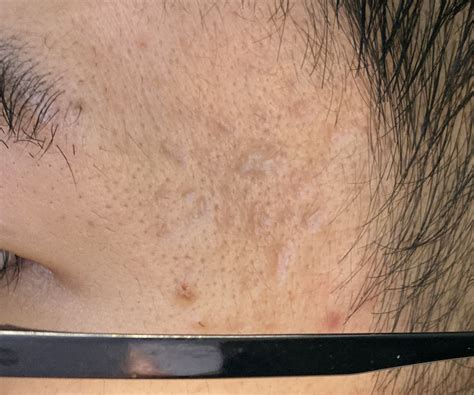 How To Best Treat These Temple Scars Scar Treatments Forum