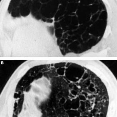 Transbronchial Lung Biopsy Specimen Taken Months After Double Lung