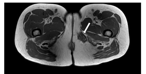 Figure 1 From Case Report Extrapelvic Endometriosis In The Medial