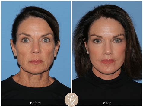 Deep Plane Facelift Case 5 Before After Photos Orange County