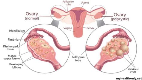 Polycystic Ovary Syndrome Pcos Symptoms Treatment And Causes