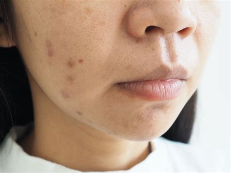 Understanding And Treating Post Inflammatory Hyperpigmentation And Post