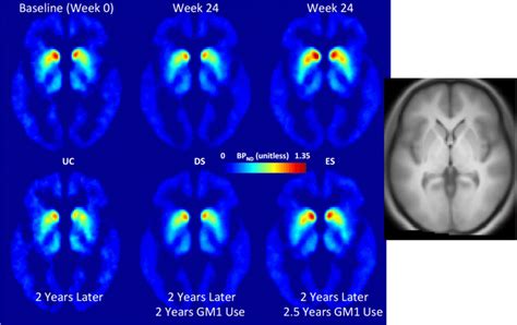 Positron Emission Tomography Pet Scanning Of Striatal Dopamine