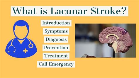 How To Treat Lacunar Stroke Youtube