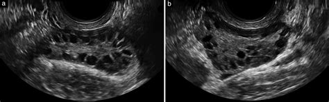 Automated Follicle Count Using Three‐dimensional Ultrasound In