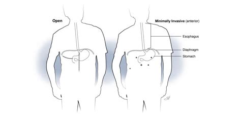 Esophagectomy Baylor Medicine