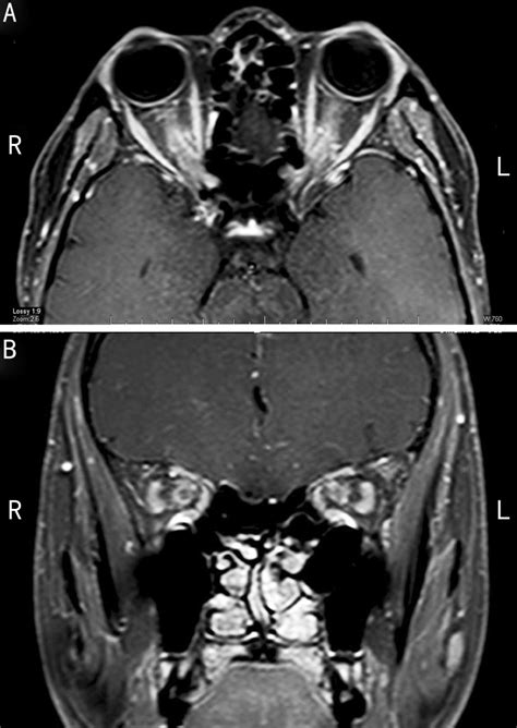 Contrast Enhanced Mri Showing Marked Enhancement Of The Optic Nerve