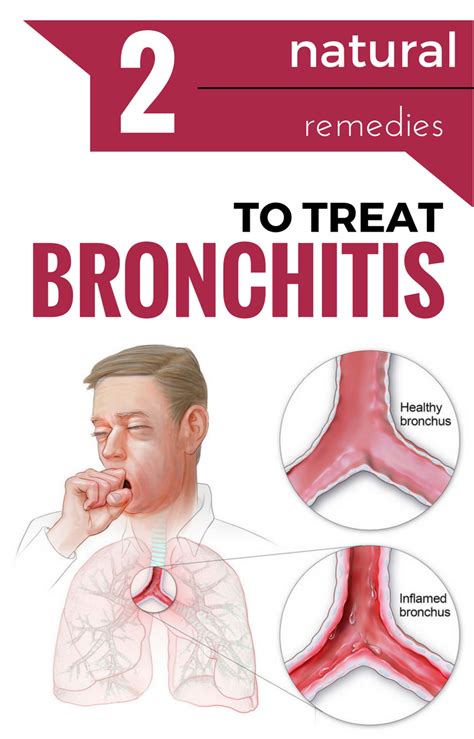 2 Natural Remedies To Treat Bronchitis Remedies