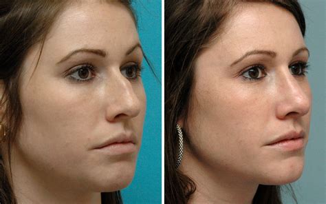 Nose Job Gallery Of Nyc Patients Before After Photos