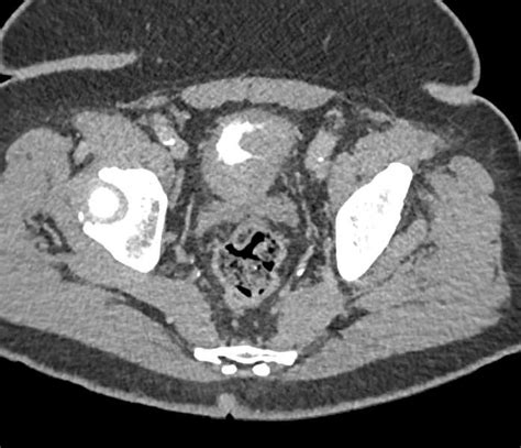 Infiltrating Bladder Cancer Genitourinary Case Studies Ctisus Ct