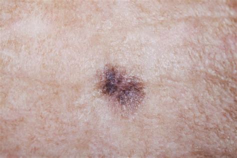 Mole Skin Cancer Symptoms Itchy Steve