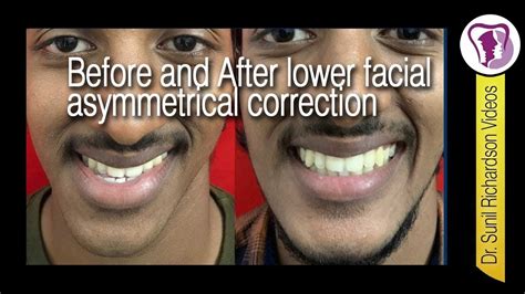 Before And After Lower Facial Asymmetrical Correction Orthognathic