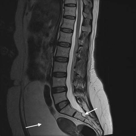 Cauda Equina Lipoma Mri