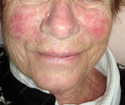 Acne Rosacea Stock Image C0294606 Science Photo Library