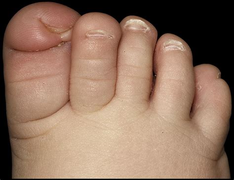 Surgical Intervention For Congenital Nail Fold Hypertrophy The