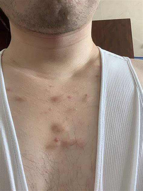 Acne Bumps On Chest